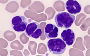 rh-atl-blood-cells 末梢血中の白血病細胞 © 2012 渡邉俊樹