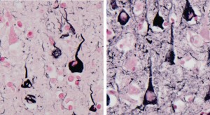 ヒトのアルツハイマー病患者の脳にみられた神経原線維変化(左、黒色の部分)とツシマヤマネコの脳にみられた神経原線維変化(右、黒色の部分) © James K. Chambers