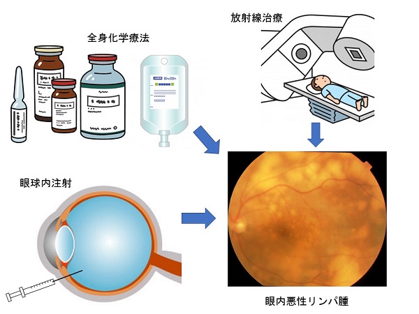 眼内悪性リンパ腫に対する三者併用療法のイメージ図 © 2017 蕪城 俊克眼内悪性リンパ腫に対して眼局所化学療法、全身化学療法、放射線治療の三者併用療法を行うことで、強力に脳再発を抑制します。